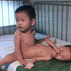 雙胞胎連體嬰手術紀錄