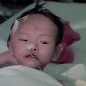 臺灣第一例連體嬰分割手術