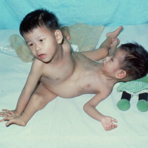 連體嬰外科手術-MOFA109179CF-2020-12-SL00018-041